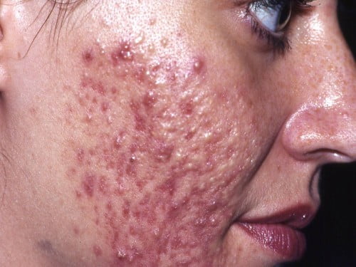 Acne conglobata op wangen, kin & voorhoofd: acne ...