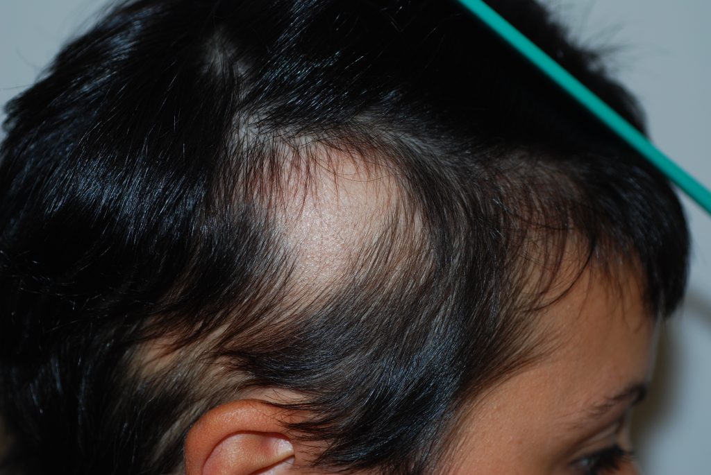 alopecia areata cure naturali