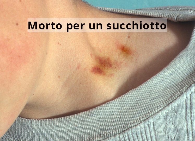 Dopo Quanto Si Muore Per Un Succhiotto